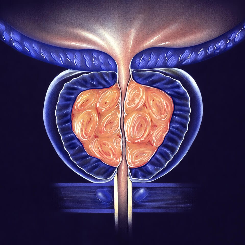 bpc 157 and enlarged prostate Enlarged Prostate (BPE)